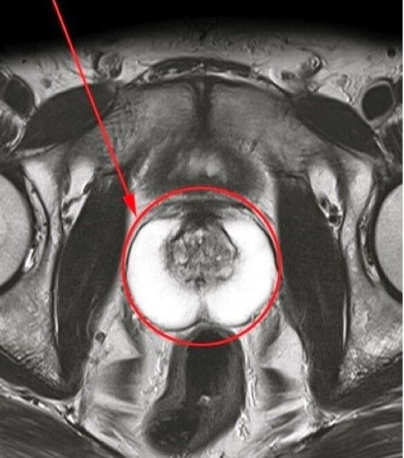 Image de capsules Predtonorm après avoir utilisé des capsules