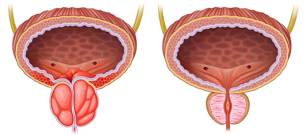 Prostate enflammée et saine après avoir utilisé des capsules de prestonorm