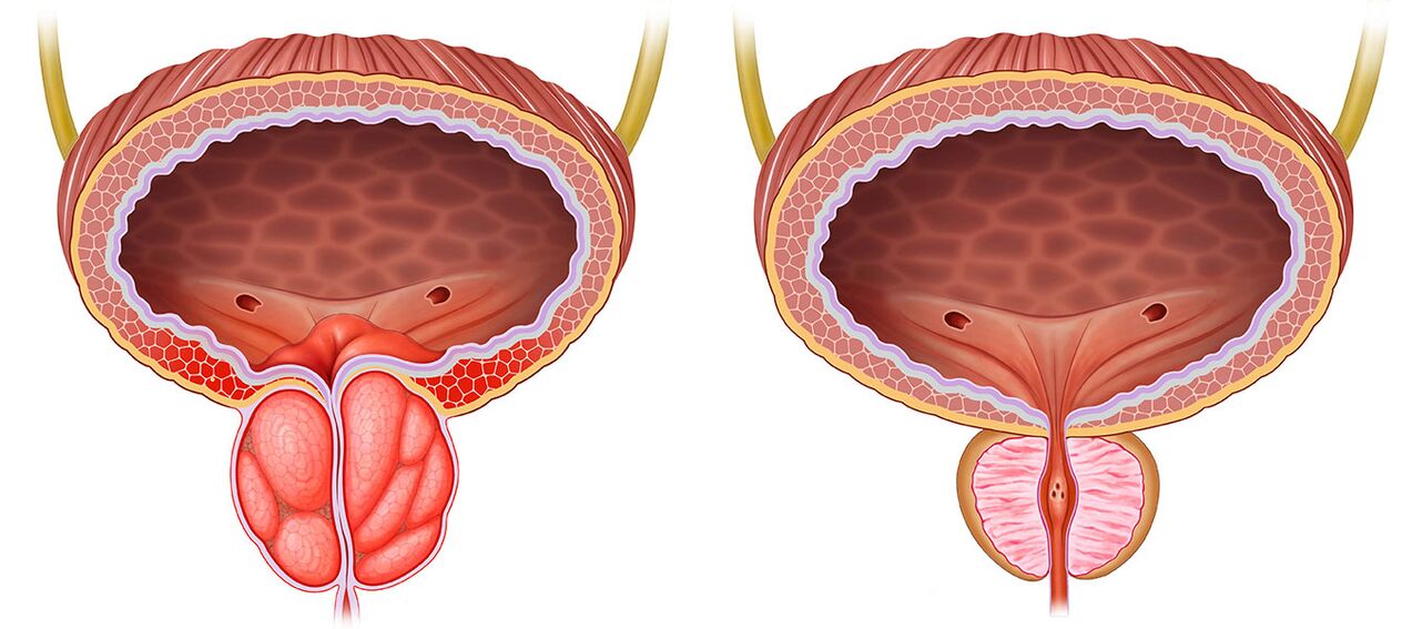 Prostate gonflée et saine après avoir utilisé les gélules Predstonorm